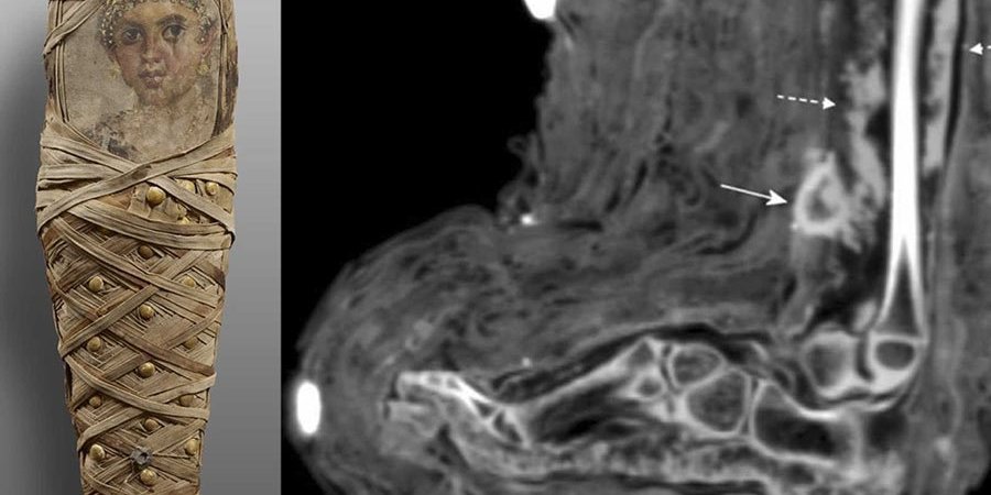 Фото мумии и следы ран на ее ноге (Фото: Panzer et. al / International Journal of Paleopathology)