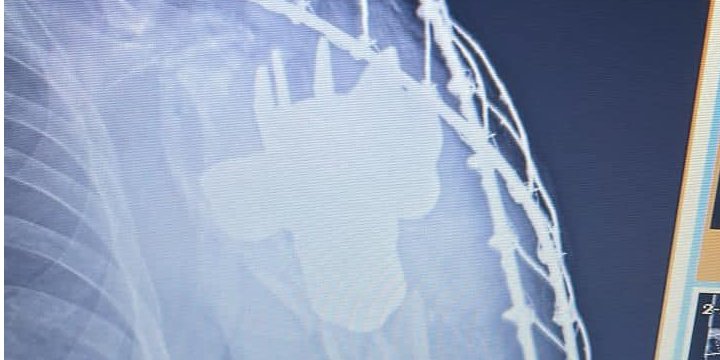 Медики успешно достали из тела военнослужащего хвостовик мины (Фото: Командування Медичних сил Збройних сил України / Facebook)