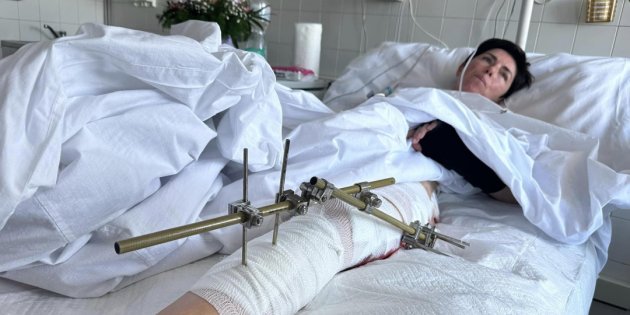 Журналістка Ольга Звонарьова відновлюється після поранення у Запоріжжі (Фото: @Укрінформ)