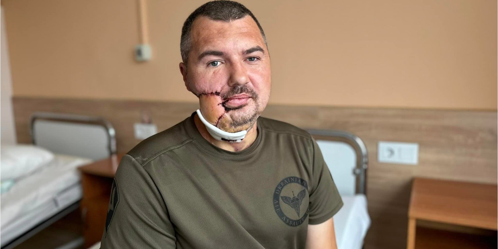Володимир чекає на реконструкція нижньої щелепи з використанням індивідуального протезу (Фото: UNBROKEN Ukraine)