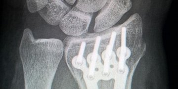 Этот материал может заменить металлические пластины и винты, которые обычно используются для фиксации сломанных костей. (Фото: pixabay)