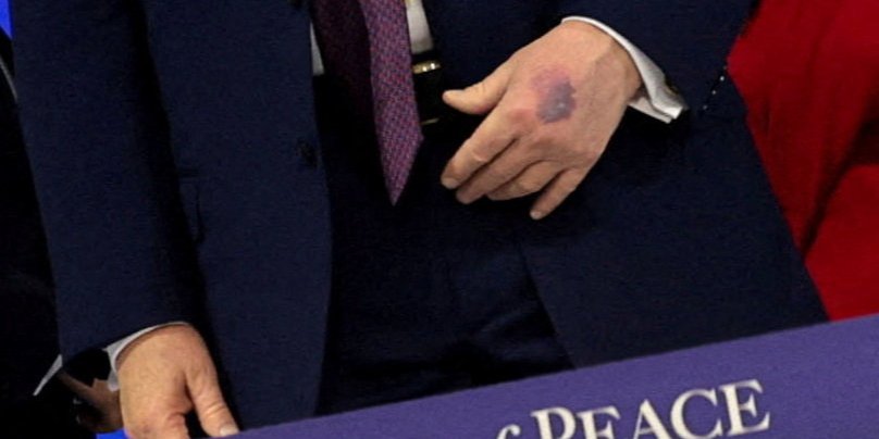 Президент США Дональд Трамп заявив, що почувається дуже добре, попри синці на руках (Фото: REUTERS/Jonathan Ernst)