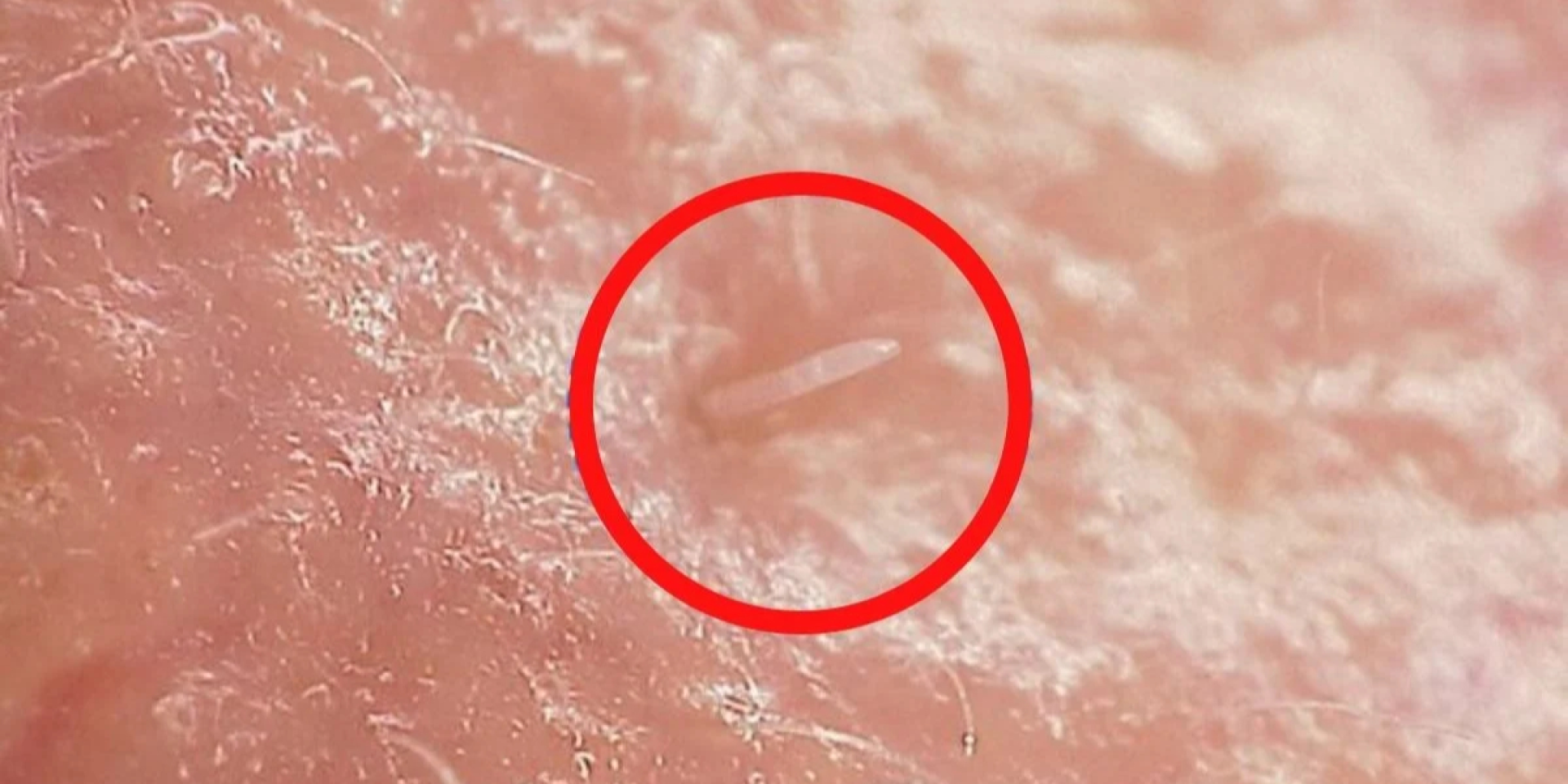 Зображення під мікроскопом, на якому видно Demodex folliculorum на шкірі людини (Фото: University of Reading)