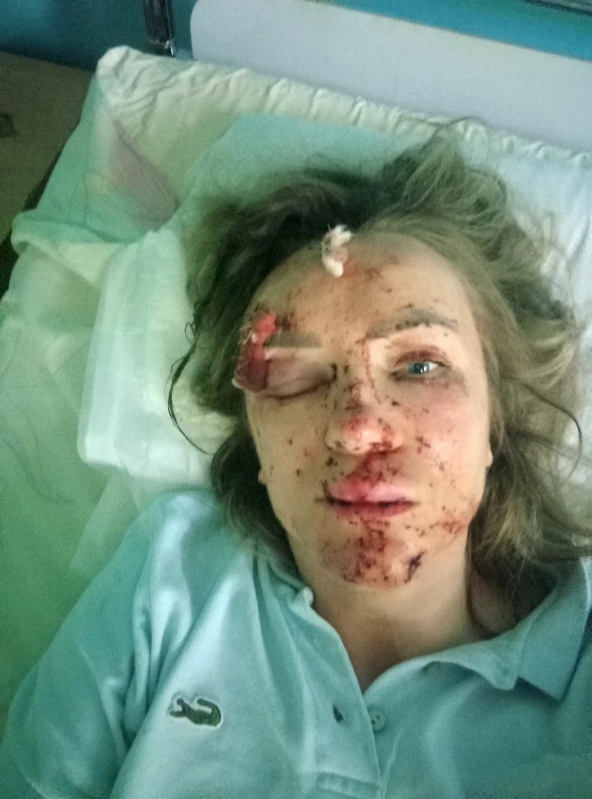 Ольга Клименко после ранения (Фото: Врятуй Красу)